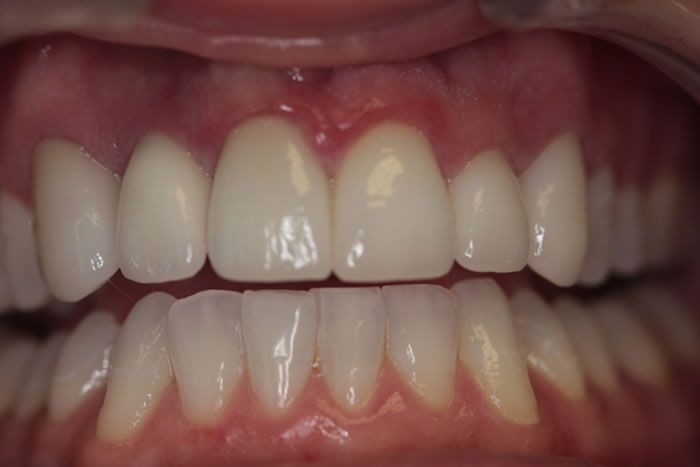 dental-implants-02-after
